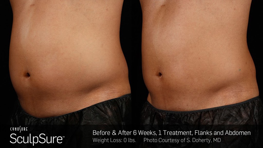 BA_SculpSure_S_Doherty_Core_2Tx_6Weeks_01.3