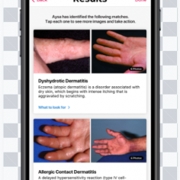 Aysa-Amazing App to help you figure out Skin Conditions!!