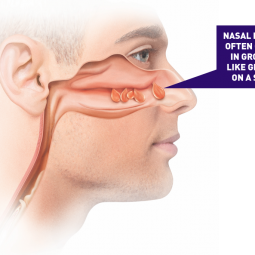 nasal polyps