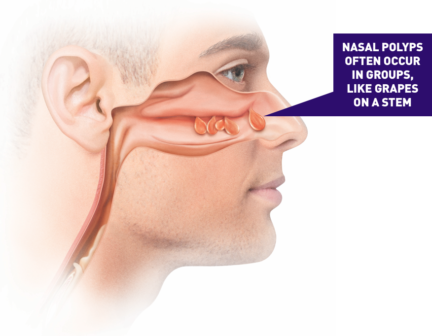 nasal polyps